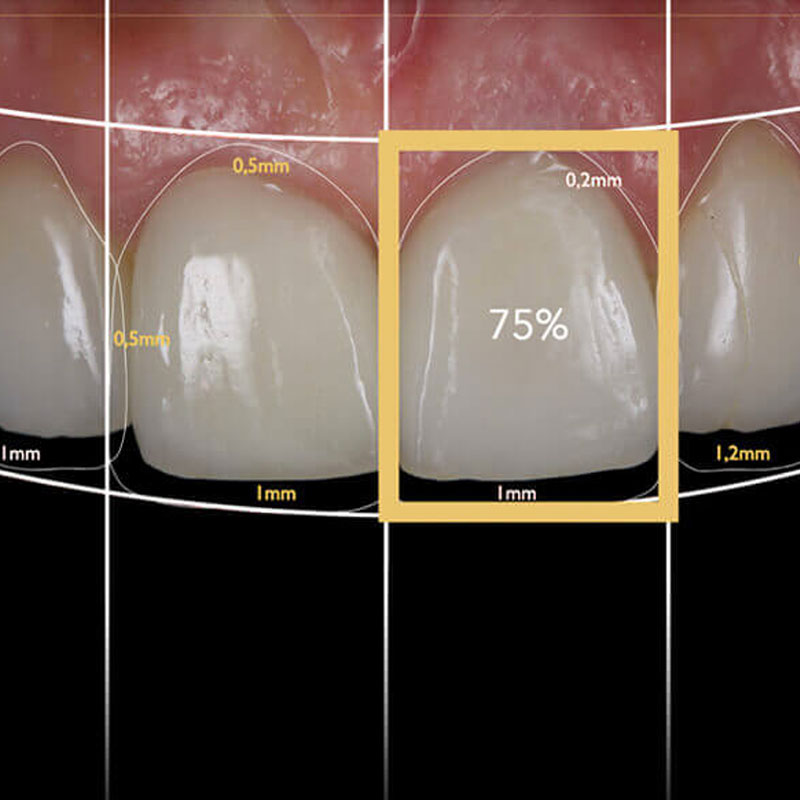 Digital Smile Design – Fallbeispiel
